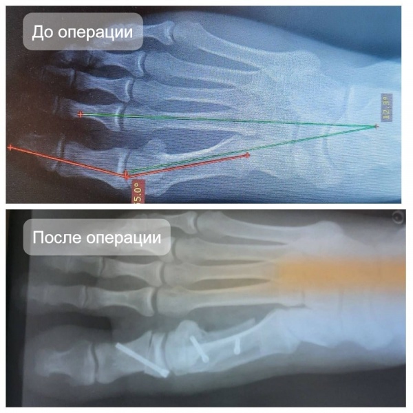 В Луховицах успешно проводят операции по коррекции "косточки на ноге"