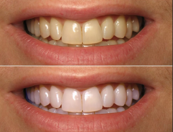 Как получить белоснежную улыбку: преимущества лазерного отбеливания зубов и другие методы