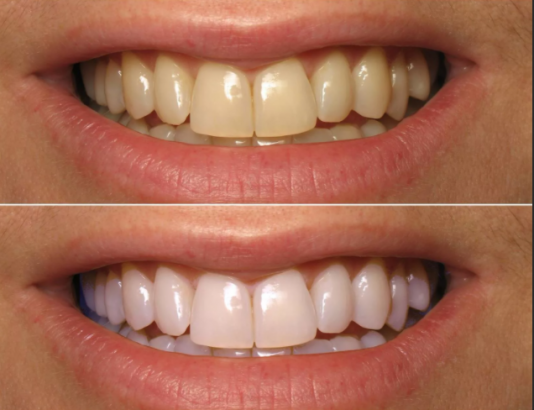 Как получить белоснежную улыбку: преимущества лазерного отбеливания зубов и другие методы