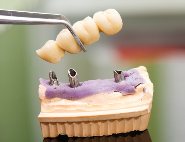 Как восстановить жевательную функцию при утрате нескольких зубов?